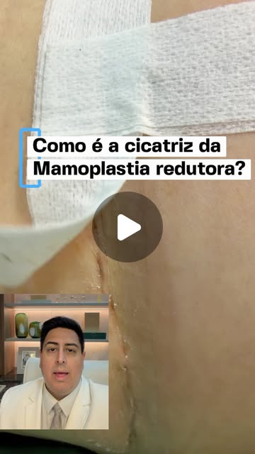 Capa do Reel: detalhe de fita cirúrgica sobre a pele, com o título “Como é a cicatriz da mamoplastia redutora?”